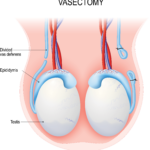 Illustration of testes, epididymides, and vasa deferentia. One vas deferens has been cut. The other vas deferens has been cut and tied closed.