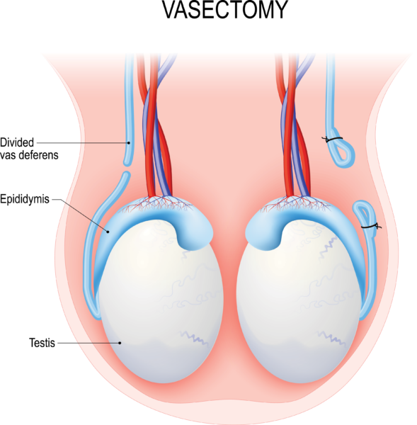 Illustration of testes, epididymides, and vasa deferentia. One vas deferens has been cut. The other vas deferens has been cut and tied closed.